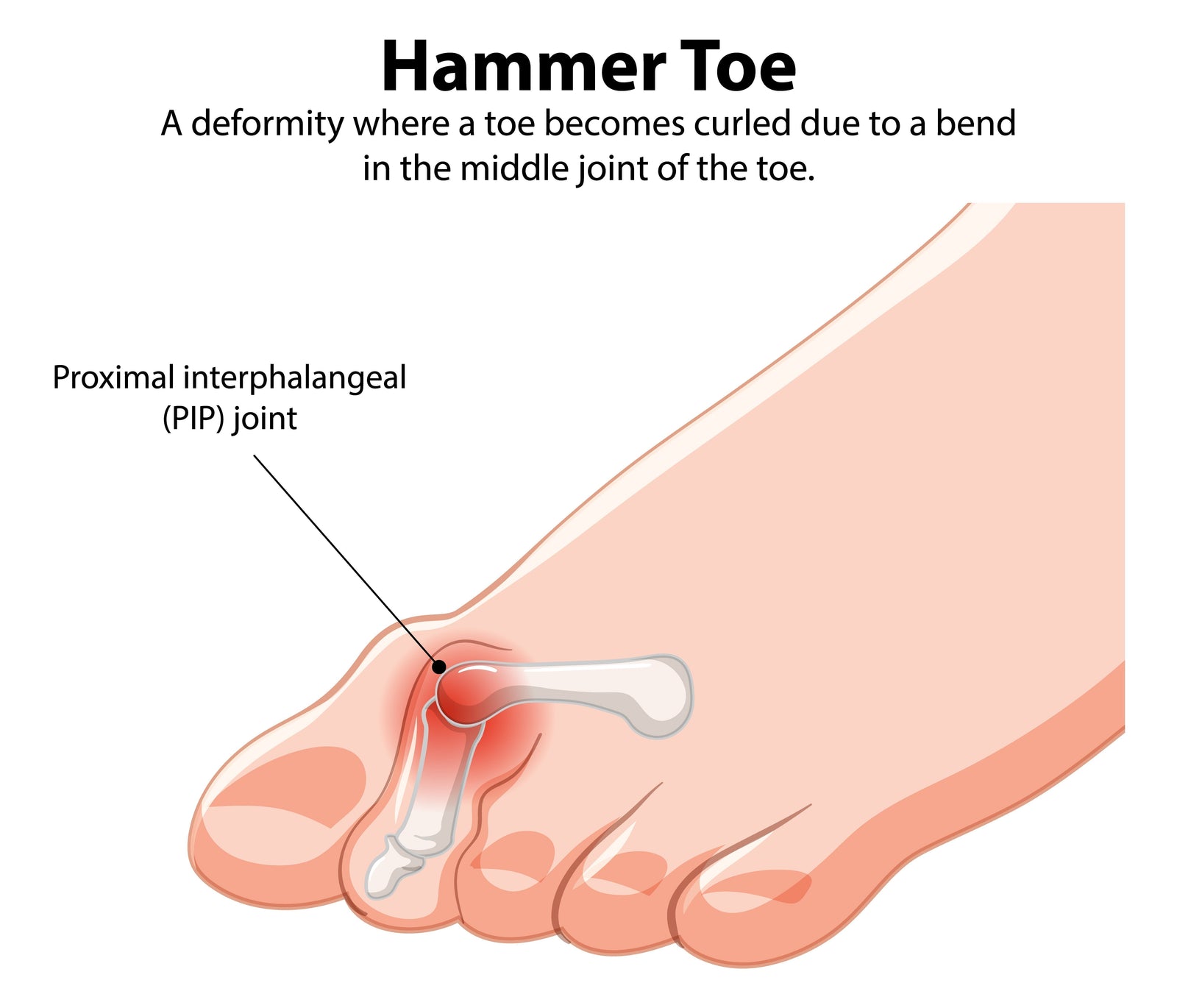 Hammertoe