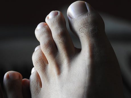 Hammer Toe